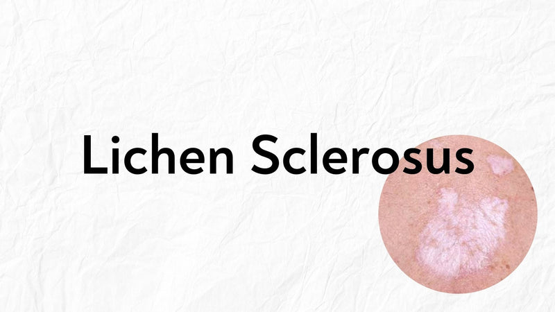 a patch of white and pinkish skin a lichens sclerosus patch